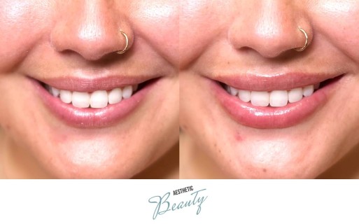Lips Before and After Image