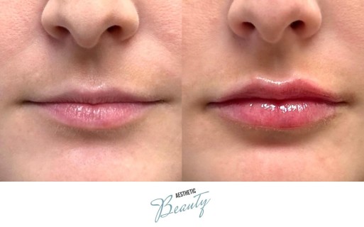 Lips Before and After Image