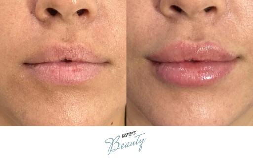 Lips Before and After Image