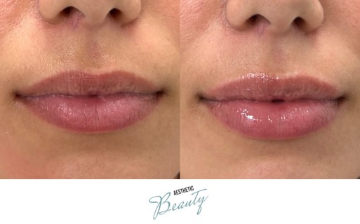Lips Before and After Image