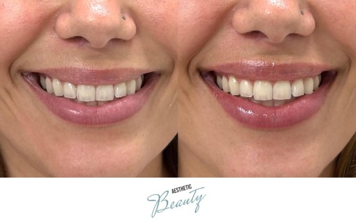 Lips Before and After Image