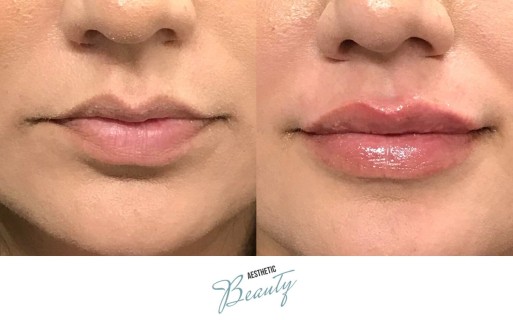 Lips Before and After Image