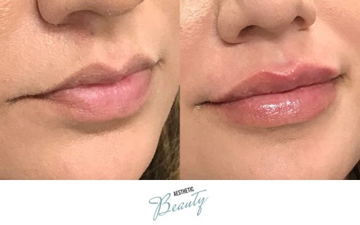 Lips Before and After Image