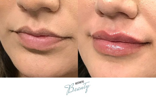 Lips Before and After Image