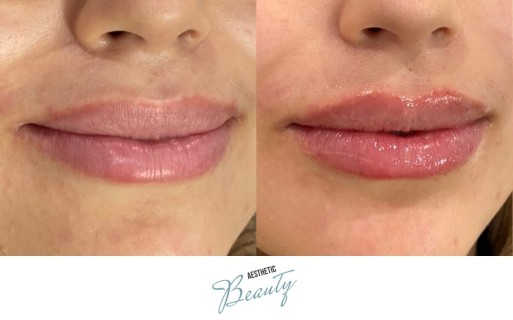 Lips Before and After Image