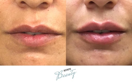 Lips Before and After Image