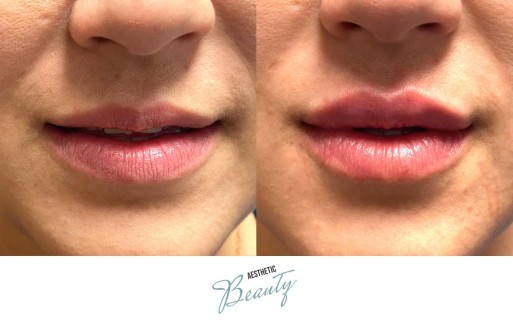 Lips Before and After Image