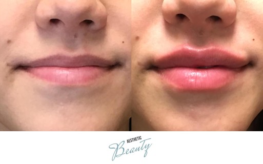 Lips Before and After Image