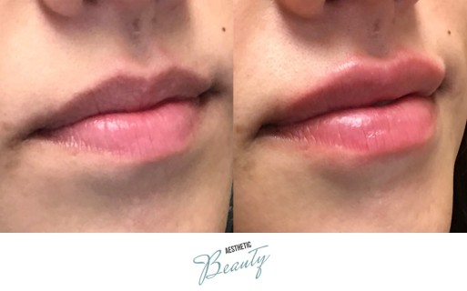 Lips Before and After Image