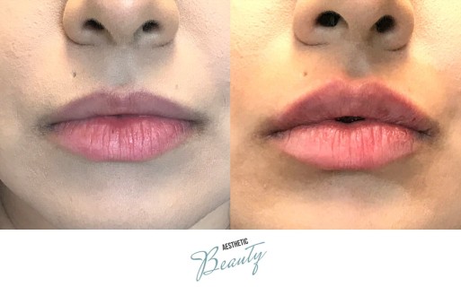 Lips Before and After Image