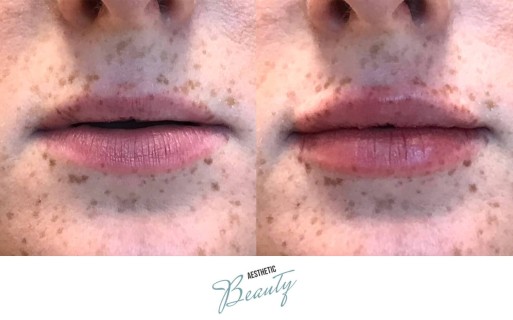 Lips Before and After Image
