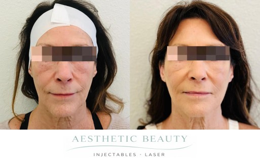 Threads Before and After Image