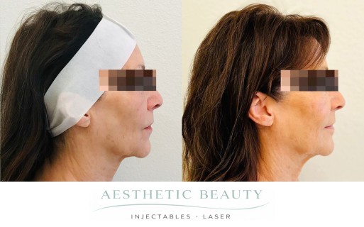 Threads Before and After Image