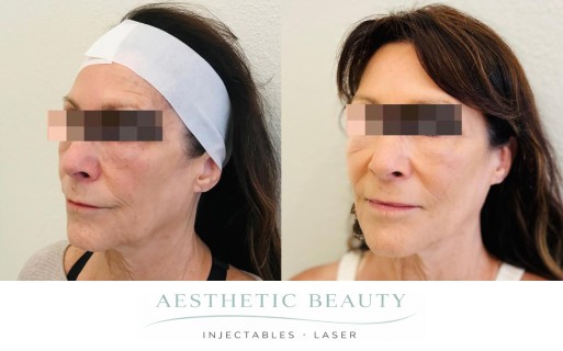Threads Before and After Image