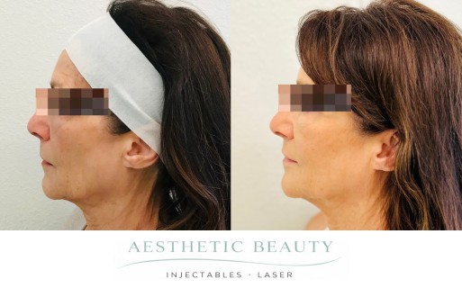 Threads Before and After Image