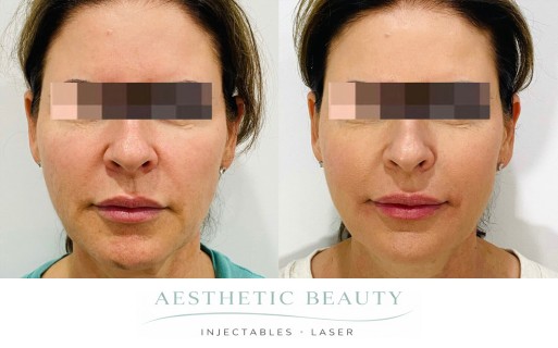 Threads Before and After Image