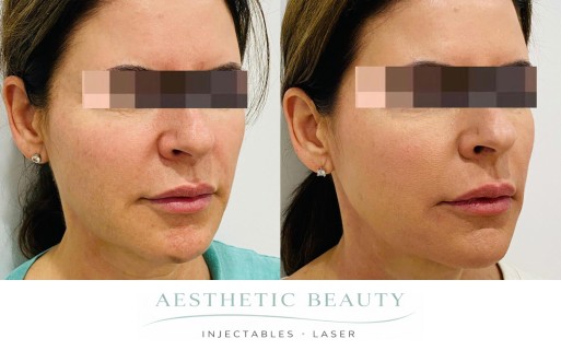 Threads Before and After Image