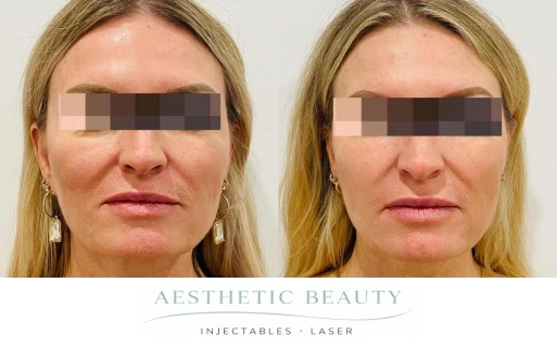 Threads Before and After Image