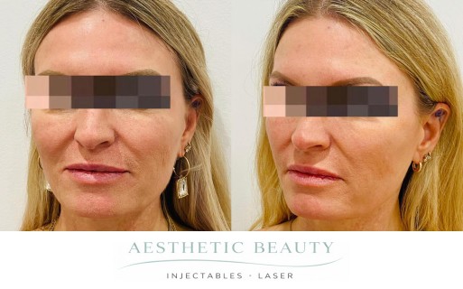 Threads Before and After Image