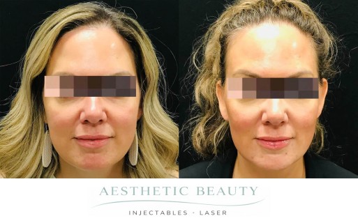 Threads Before and After Image