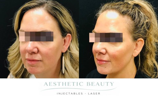 Threads Before and After Image