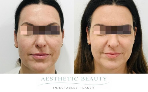 Threads Before and After Image