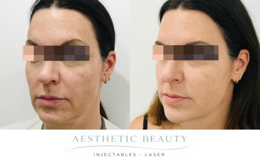 Threads Before and After Image