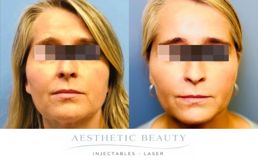 Threads Before and After Image