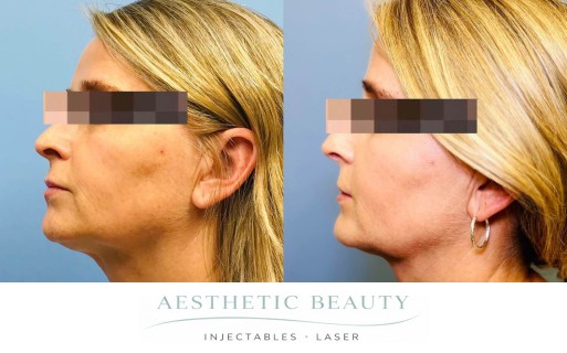 Threads Before and After Image