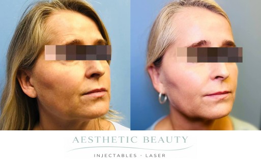 Threads Before and After Image