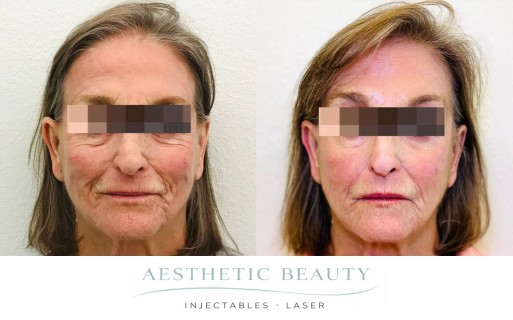 Threads Before and After Image