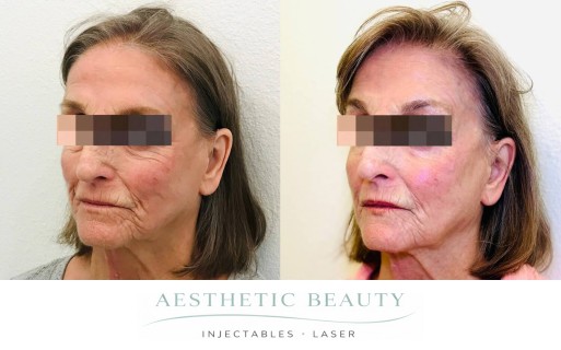 Threads Before and After Image