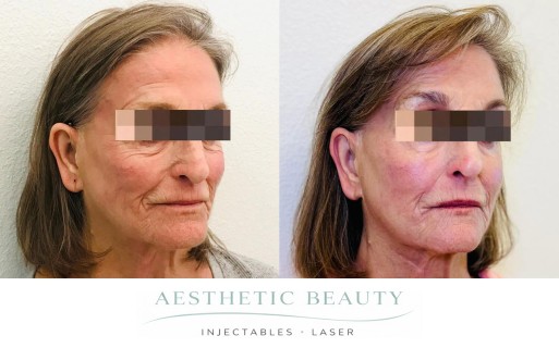 Threads Before and After Image