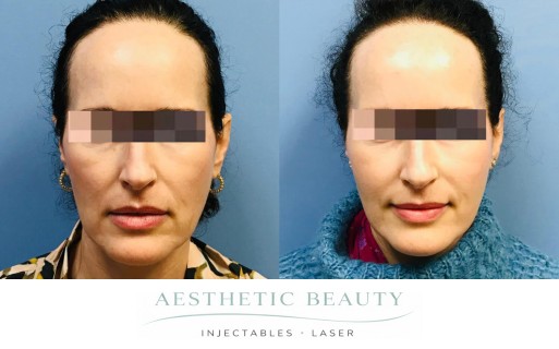 Threads Before and After Image