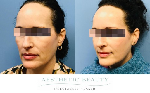 Threads Before and After Image