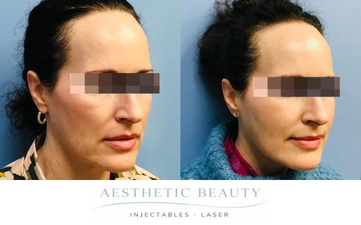 Threads Before and After Image