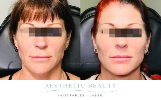 Threads Before and After Image