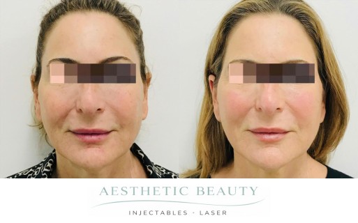 Threads Before and After Image