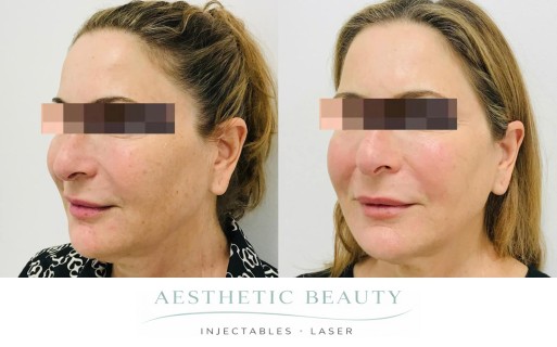 Threads Before and After Image
