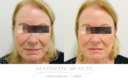 Threads Before and After Image
