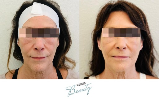 Threads Before and After Image