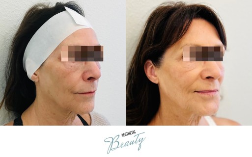 Threads Before and After Image