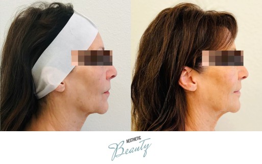 Threads Before and After Image