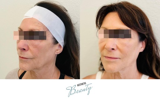 Threads Before and After Image