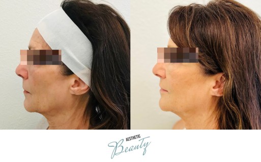 Threads Before and After Image