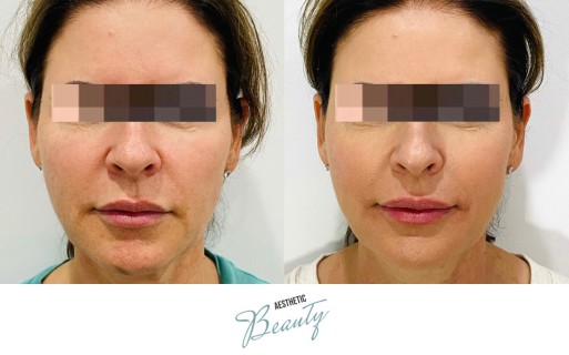 Threads Before and After Image