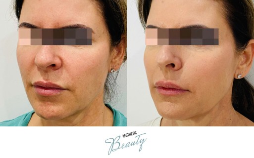 Threads Before and After Image