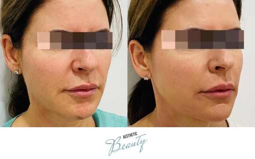 Threads Before and After Image