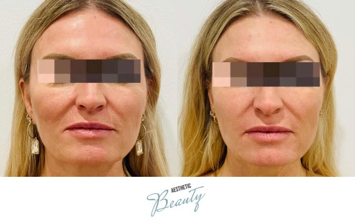 Threads Before and After Image