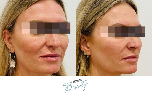 Threads Before and After Image